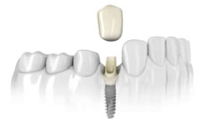 Dr. Mika - Dental Implants