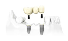 Dr. Mika - Dental Implants