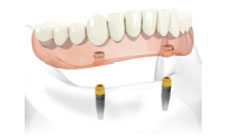 Dr. Mika - Dental Implants