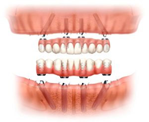 Dr. Mika - Dental Implants